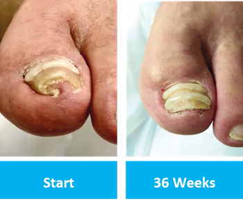 OnyfixBeforeAfter