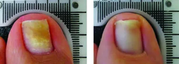lunula-laser-b-a-patient