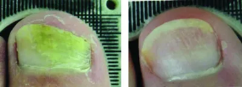 lunula-laser-b-a-patient