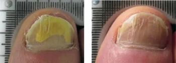 lunula-laser-b-a-patient